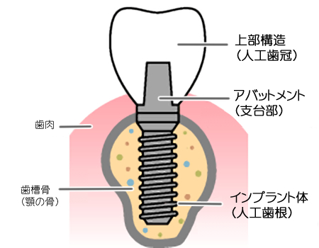 インプラントの構造