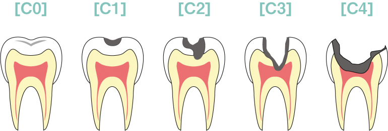 虫歯の進行