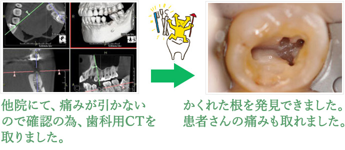 根管治療