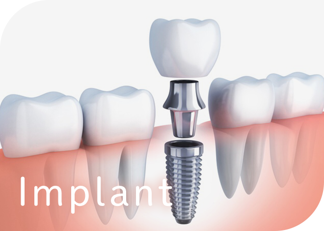 Implant